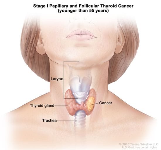 Celebrities Help Raising Awareness for Thyroid Cancer